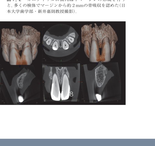 攻めのクラウン・ブリッジ