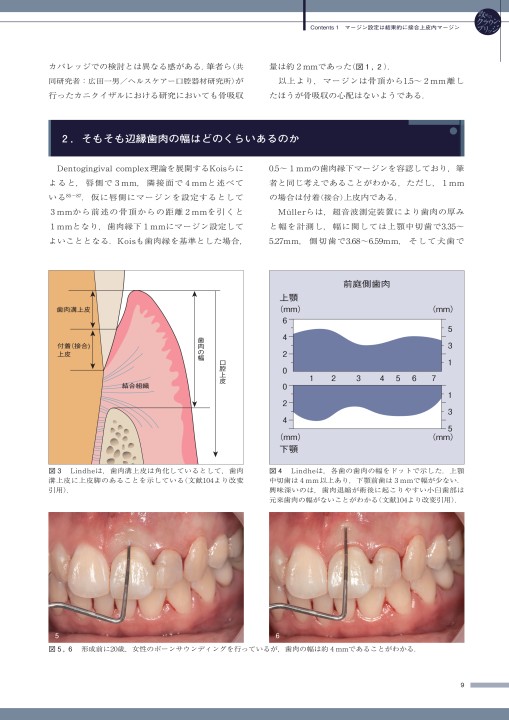 攻めのクラウン・ブリッジ