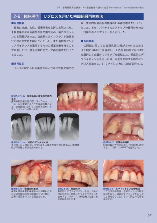 実践例から学ぶ歯周外科手術の組み立てかた - クインテッセンス出版