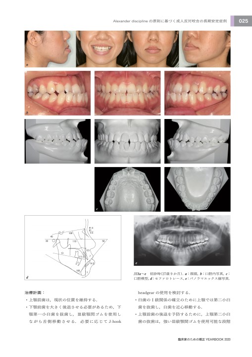 ▲01)【同梱不可】歯科矯正臨床シリーズ 4冊セット/その基礎と臨床/上顎前突/反対咬合/叢生/開咬/医歯薬出版/A 治療例No.104 正常咬合ではありません上下顎前突です。｜舌側