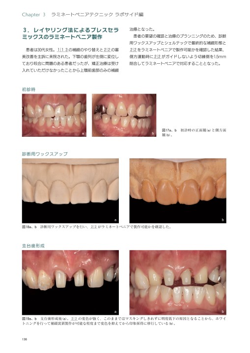 歯科医師・歯科技工士のための最新ラミネートベニア ─現在の