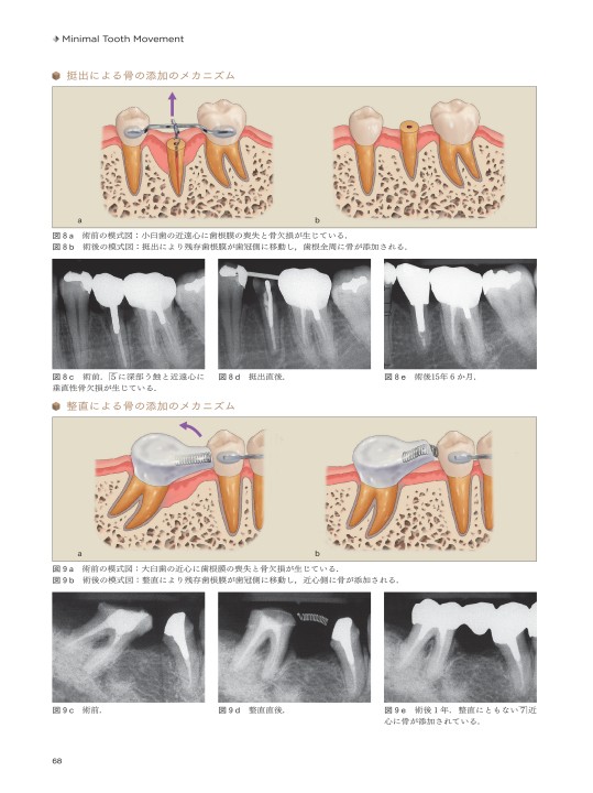 増補新版 Minimal Tooth Movement