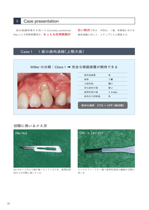イラストレイテッド 安全・安心・確実 根面被覆術 (イラストレイ