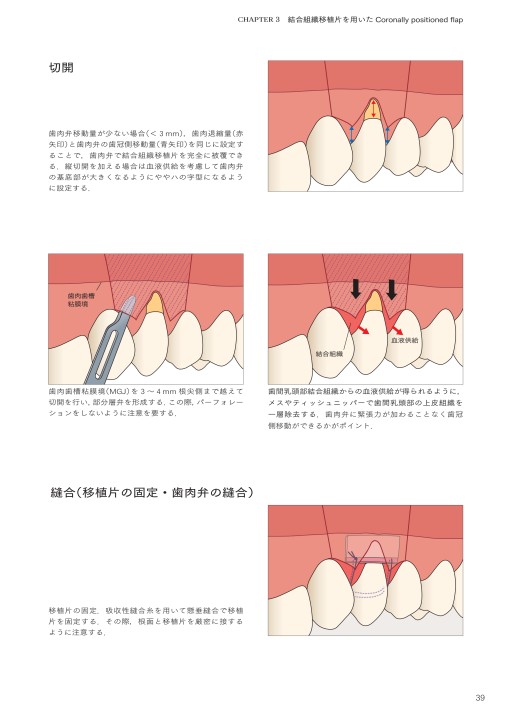イラストレイテッド 安全・安心・確実 根面被覆術