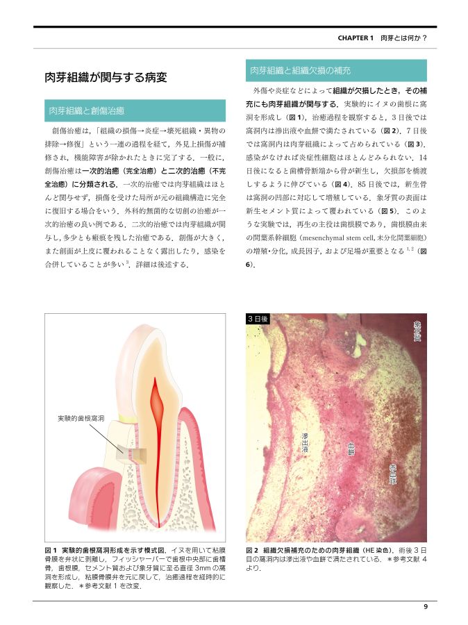 肉芽の科学と臨床 : ぺリオ・抜歯・エンド・GBR・インプラント周囲炎での対応… 416ntL63ghL.jpg_BO30,255,255,
