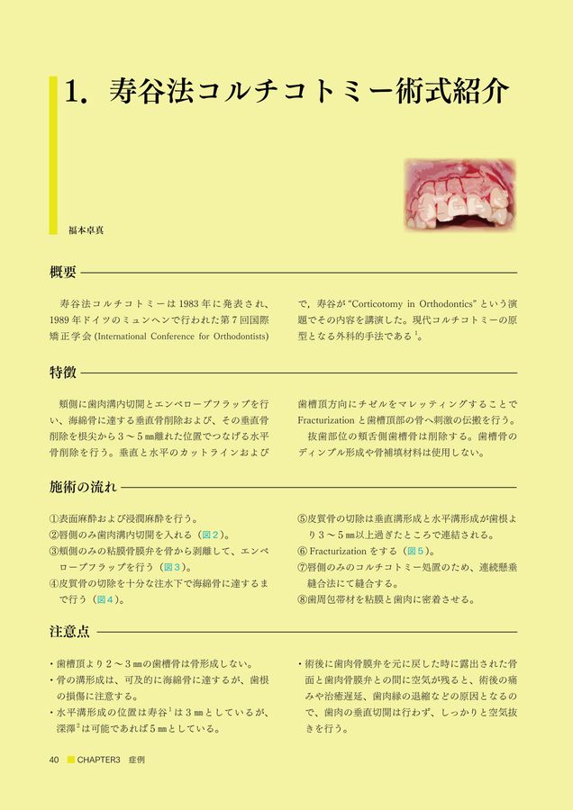 加速矯正