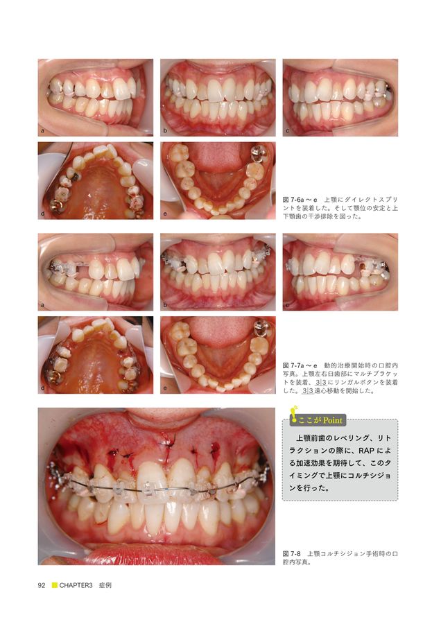 加速矯正 加速矯正