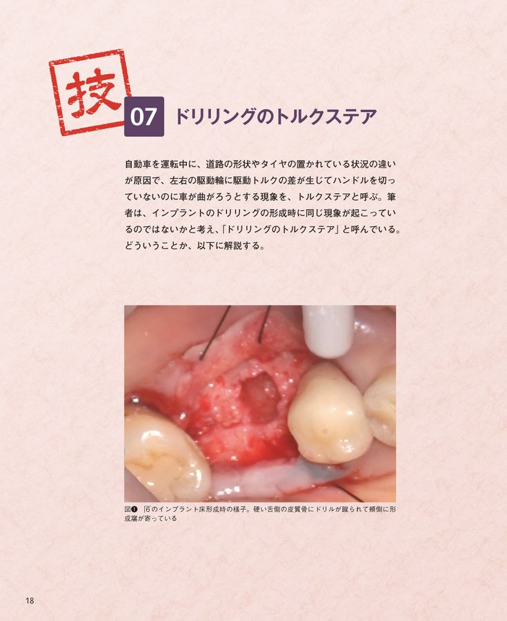 インプラント裏技帖50