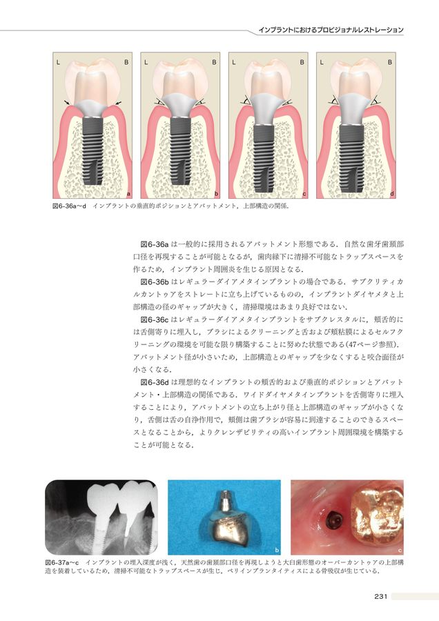 ザ・プロビジョナルレストレーションズII: 補綴治療の長期的成功