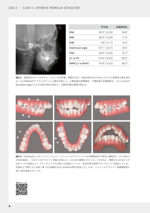 THE ALIGNER ORTHO