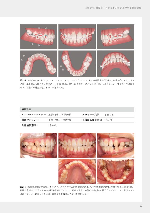 THE ALIGNER ORTHO