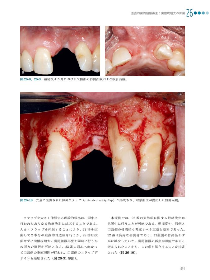 Vertical 2 骨造成 垂直的および水平的歯槽堤増大術の完成形 61frUlR8VjL.jpg