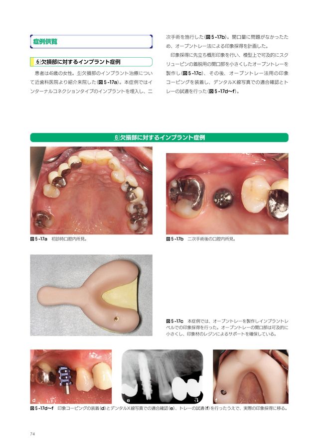 基本から学び直すインプラント補綴 基本から学び直すインプラント補綴: 今さら聞けない・でも知り