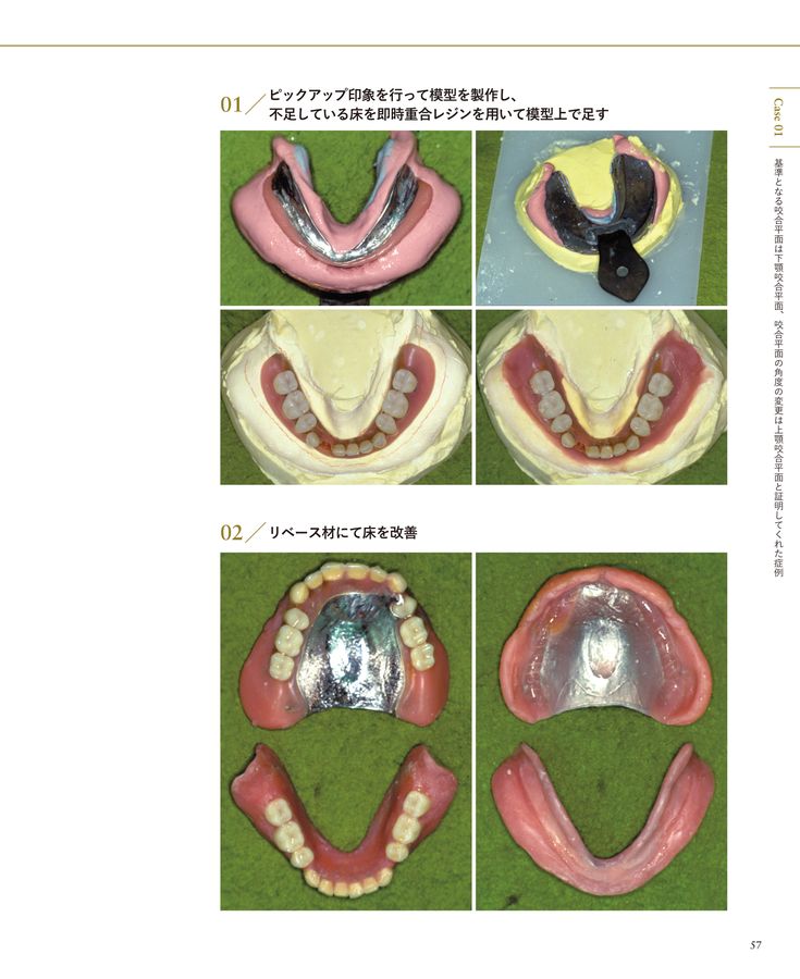 総義歯の病理―基礎と臨床から導き出された総義歯製作法
