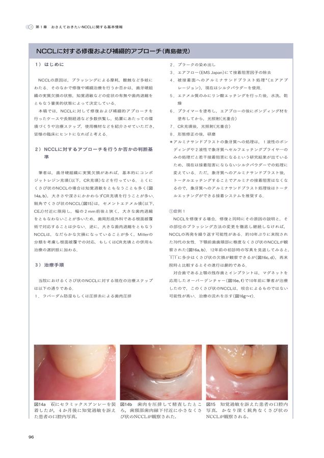 非う蝕性歯頸部歯質欠損 NCCL