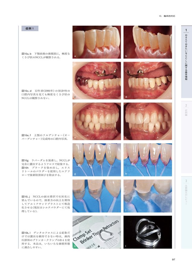 非う蝕性歯頸部歯質欠損 NCCL