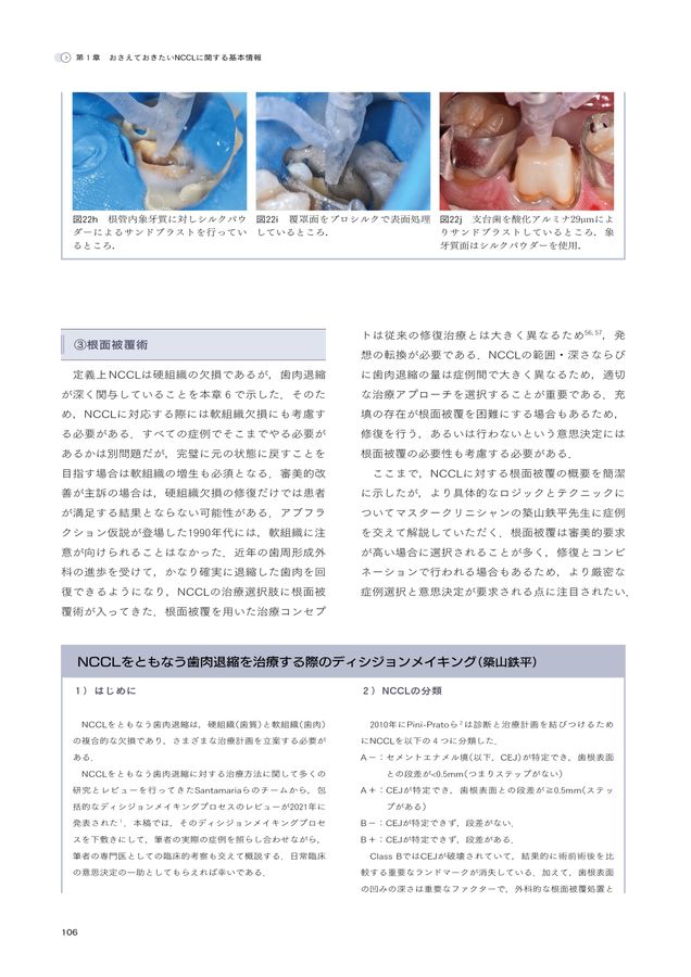 非う蝕性歯頸部歯質欠損 NCCLの購入ならWHITE CROSS