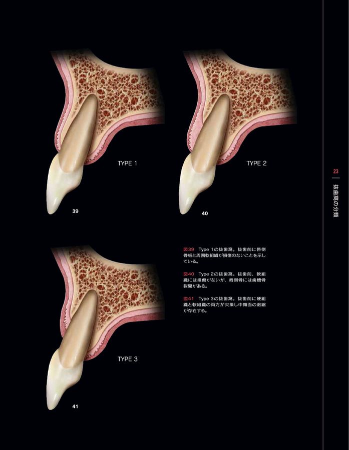 シングル・トゥースインプラント: 前歯部および臼歯部抜歯窩