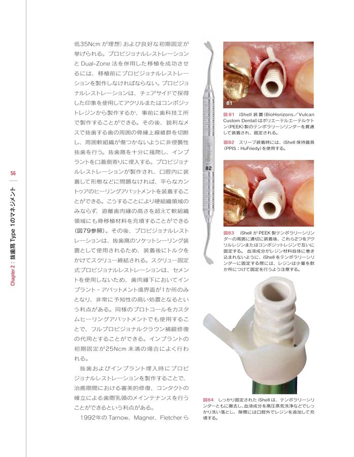 シングル・トゥースインプラント: 前歯部および臼歯部抜歯窩