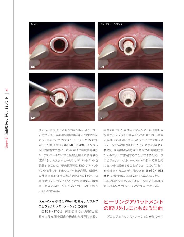 シングル・トゥースインプラント: 前歯部および臼歯部抜歯窩