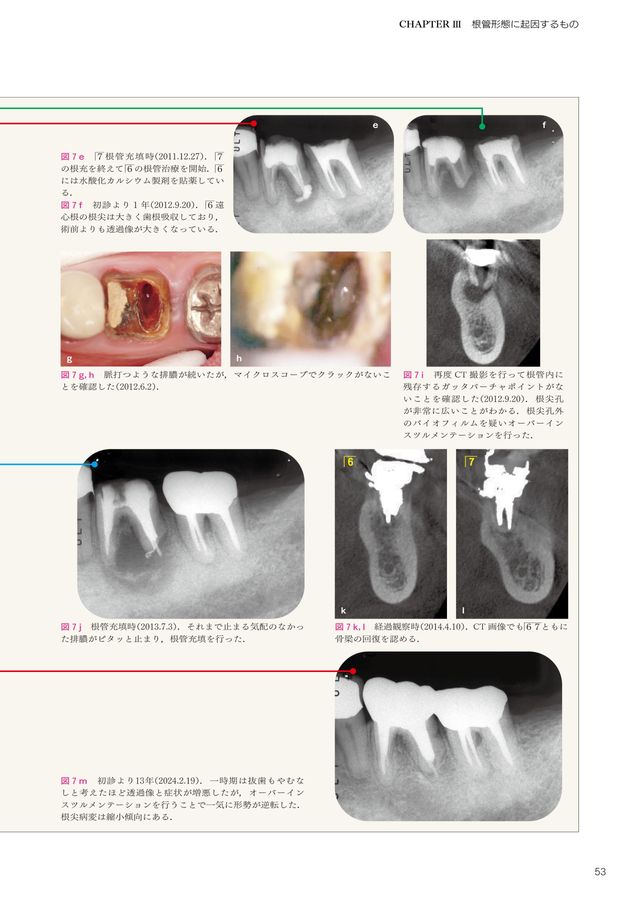 悩めるエンド難症例 診断のポイントとその対応