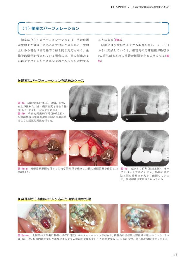 悩めるエンド難症例 診断のポイントとその対応