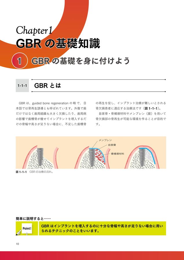 GBRの歯科インプラントへの応用 GBRの歯科インプラントへの応用