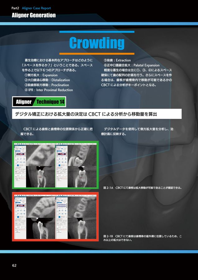 アライナージェネレーション※裁断済 ⚠裁断済ALIGNER GENERATION アライナー ジェネレーション