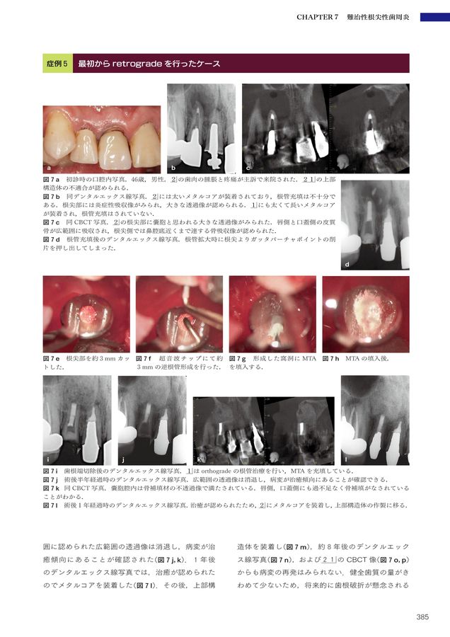 5-Dコンセンサス 歯の保存にこだわる