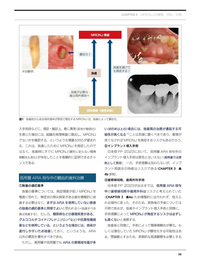 薬剤・ビスフォスフォネート関連顎骨壊死 MRONJ・BRONJ 薬剤関連顎骨壊死