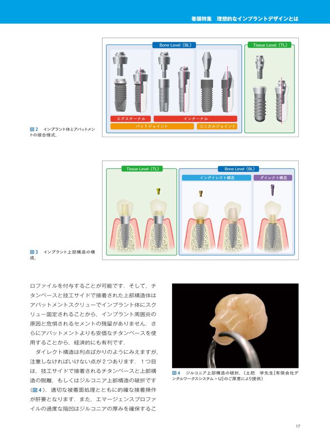 インプラント YEARBOOK 2025 インプラント YEARBOOK 2025: 理想的なインプラントデザインとは