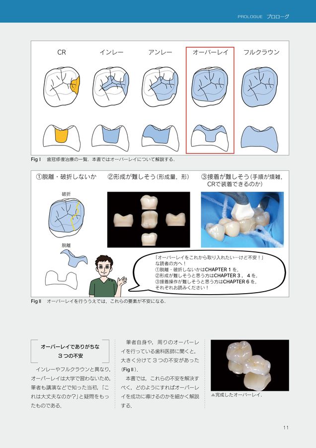 オーバーレイ修復超入門※裁断済 オーバーレイ修復 超入門 - クインテッセンス出版