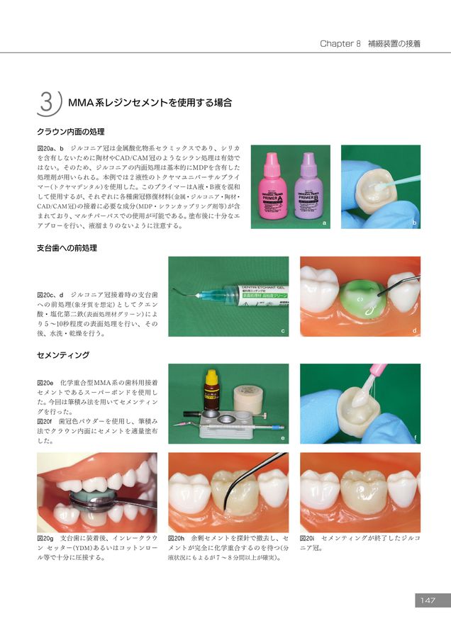 必ず上達 デジタル時代の歯冠修復