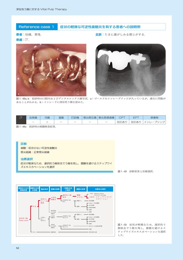 Vital Pulp Therapy 深在性う蝕に対する治療法 深在性う蝕に対するVital Pulp Therapy - クインテッセンス出版