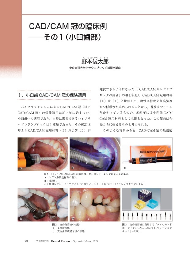 CAD/CAM冠 CAD/CAMインレー