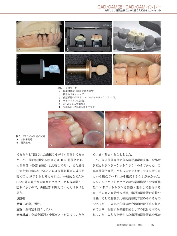 CAD/CAM冠 CAD/CAMインレー