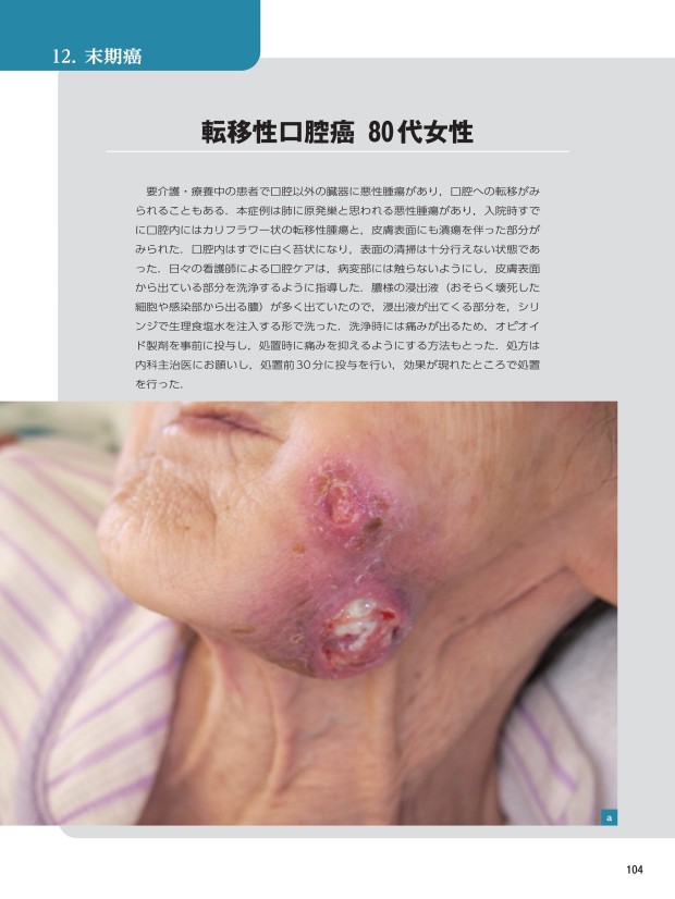 口腔病変クローズアップ young-woman-showing-tongue-
