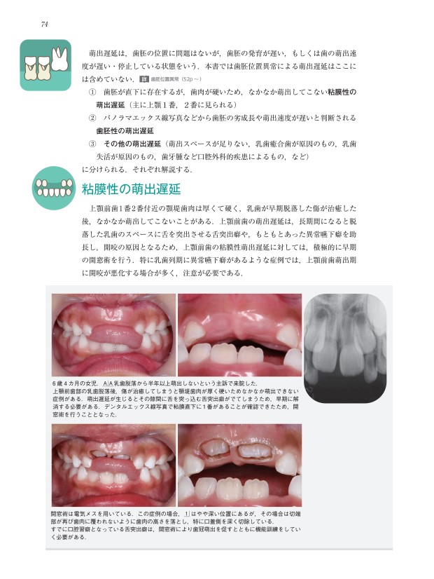 裁断済み　萌出障害 : 先天欠如,歯胚位置異常,萌出遅延,過剰歯,捻転歯 Amazon.co.jp: 萌出障害―先天欠如,歯胚位置異常,萌出遅延,過剰歯