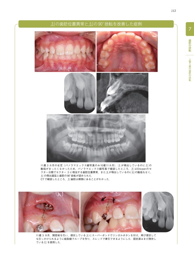 裁断済み　萌出障害 : 先天欠如,歯胚位置異常,萌出遅延,過剰歯,捻転歯 萌出障害～先天欠如、歯胚位置異常、萌出遅延、過剰歯、捻転歯