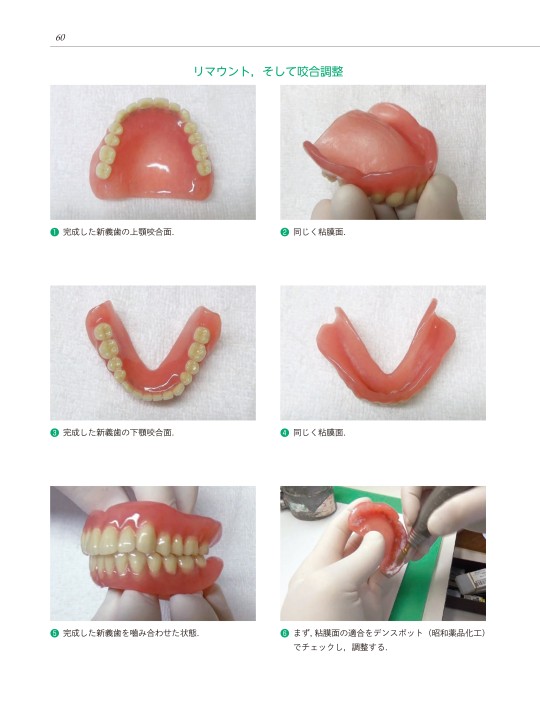 総義歯の痛い外れるにどう対処するか
